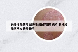 长沙湘雅医院皮肤科能治好银屑病吗 长沙湘雅医院皮肤科贵吗