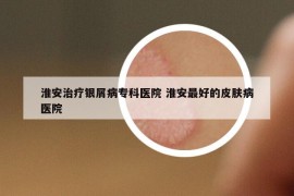 淮安治疗银屑病专科医院 淮安最好的皮肤病医院