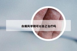 白癜风早期可以自己治疗吗