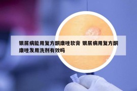 银屑病能用复方酮康唑软膏 银屑病用复方酮康唑发用洗剂有效吗