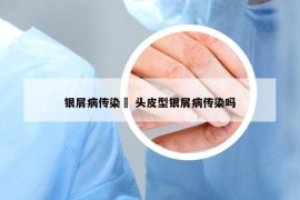 银屑病传染嗎 头皮型银屑病传染吗