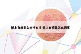 腿上有癣怎么治疗方法 腿上有癣是怎么回事