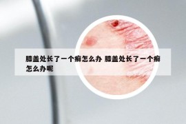 膝盖处长了一个癣怎么办 膝盖处长了一个癣怎么办呢