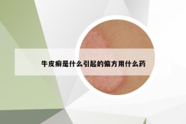 牛皮癣是什么引起的偏方用什么药