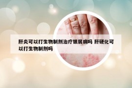 肝炎可以打生物制剂治疗银屑病吗 肝硬化可以打生物制剂吗