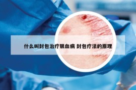 什么叫封包治疗银血病 封包疗法的原理