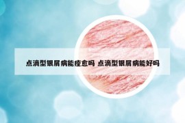 点滴型银屑病能痊愈吗 点滴型银屑病能好吗