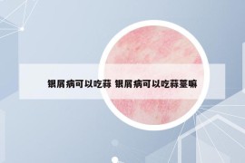 银屑病可以吃蒜 银屑病可以吃蒜薹嘛