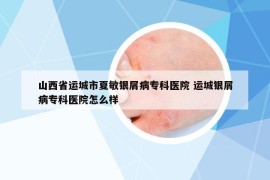 山西省运城市夏敏银屑病专科医院 运城银屑病专科医院怎么样