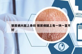 银屑病大腿上条纹 银屑病腿上有一块一直不好