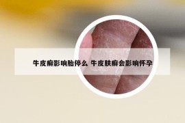 牛皮癣影响胎停么 牛皮肤癣会影响怀孕