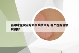 昌哪家医院治疗银屑病技术好 哪个医院治银屑病好