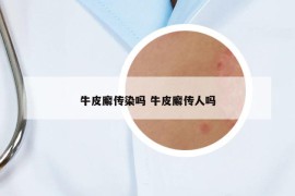 牛皮廨传染吗 牛皮廨传人吗