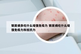 银屑病多吃什么增强免疫力 银屑病吃什么增强免疫力和抵抗力