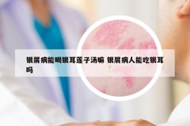 银屑病能喝银耳莲子汤嘛 银屑病人能吃银耳吗