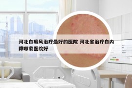 河北白癜风治疗最好的医院 河北省治疗白内障哪家医院好