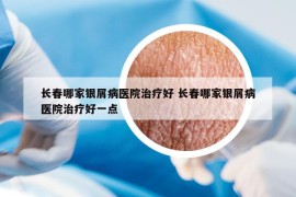 长春哪家银屑病医院治疗好 长春哪家银屑病医院治疗好一点