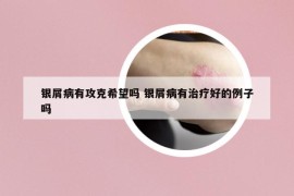 银屑病有攻克希望吗 银屑病有治疗好的例子吗