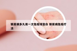 银屑病多久用一次免疫球蛋白 银屑病免疫疗法