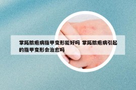 掌跖脓疱病指甲变形能好吗 掌跖脓疱病引起的指甲变形会治愈吗