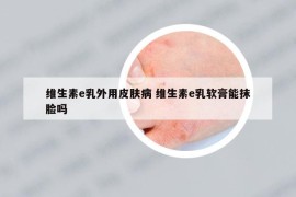 维生素e乳外用皮肤病 维生素e乳软膏能抹脸吗