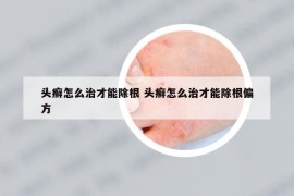 头癣怎么治才能除根 头癣怎么治才能除根偏方