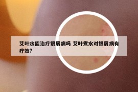 艾叶水能治疗银屑病吗 艾叶煮水对银屑病有疗效?