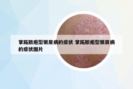 掌跖脓疱型银屑病的症状 掌跖脓疱型银屑病的症状图片