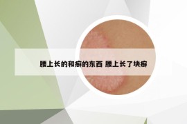 腰上长的和癣的东西 腰上长了块癣