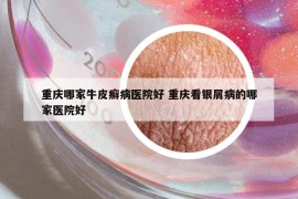 重庆哪家牛皮癣病医院好 重庆看银屑病的哪家医院好