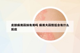 皮肤癣用蒜抹有用吗 癣用大蒜擦后会有什么反应