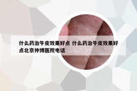 什么药治牛皮效果好点 什么药治牛皮效果好点北京仲博医院电话