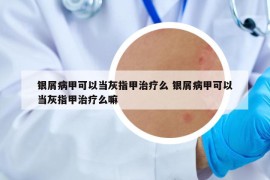 银屑病甲可以当灰指甲治疗么 银屑病甲可以当灰指甲治疗么嘛