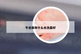 牛皮癣用什么水洗最好