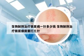 生物制剂治疗银屑病一针多少钱 生物制剂治疗银屑病需要打几针