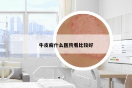 牛皮癣什么医院看比较好