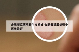 合肥哪家医院看牛皮癣好 合肥看银屑病哪个医院最好