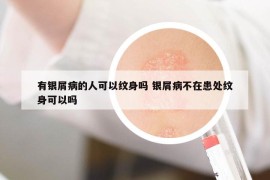 有银屑病的人可以纹身吗 银屑病不在患处纹身可以吗