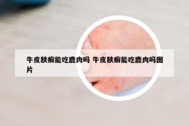 牛皮肤癣能吃鹿肉吗 牛皮肤癣能吃鹿肉吗图片