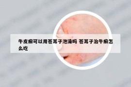 牛皮癣可以用苍耳子泡澡吗 苍耳子治牛癣怎么吃