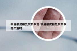 银屑病皮损处发白发亮 银屑病皮损处发白发亮严重吗