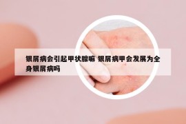 银屑病会引起甲状腺嘛 银屑病甲会发展为全身银屑病吗