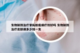 生物制剂治疗掌跖脓疱病疗效好吗 生物制剂治疗皮肤病多少钱一支