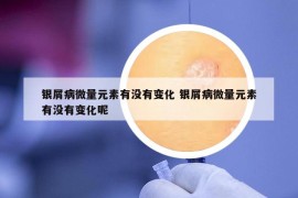 银屑病微量元素有没有变化 银屑病微量元素有没有变化呢