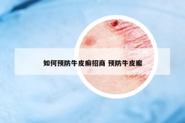 如何预防牛皮癣招商 预防牛皮廨