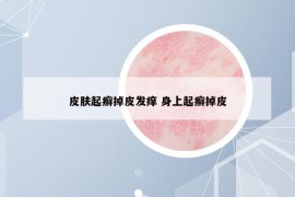 皮肤起癣掉皮发痒 身上起癣掉皮