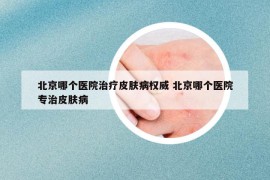 北京哪个医院治疗皮肤病权威 北京哪个医院专治皮肤病