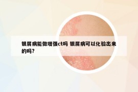 银屑病能做增强ct吗 银屑病可以化验出来的吗?