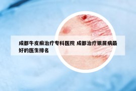 成都牛皮癣治疗专科医院 成都治疗银屑病最好的医生排名