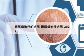 银屑病治疗的进展 银屑病治疗进展 2022